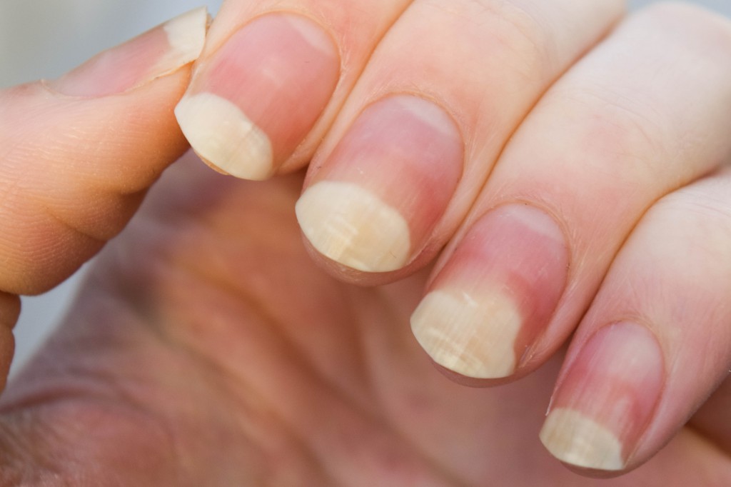 svamp på nageln